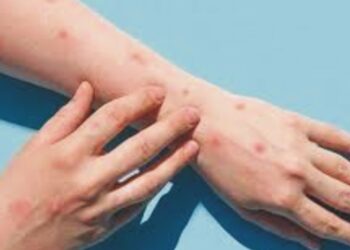 عالمی سطح پر تیزی سے پھیلنے والے ایم پی اوکس کیسز کے پھیلاؤ کو روکنے کے لیےحکومت کو ایک جارحانہ حکمت عملی کی سختی سے سفارش کی ہے، پروفیسر جاوید اکرم چیئرمینTWG پنجاب